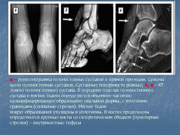 a – рентгенограмма голеностопных суставов в прямой проекции. Сужены щели голеностопных суставов. Суставные поверхности