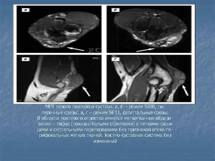 МРТ левого локтевого сустава. а, б – режим STIR, поперечные срезы; в, г –