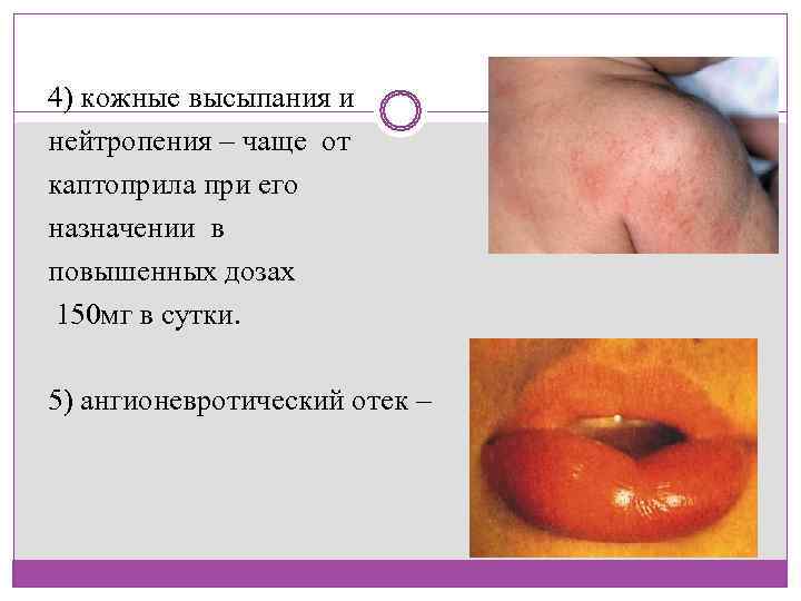  нижних конечностей, гипотензия, сонливость. 4) кожные высыпания и нейтропения – чаще от каптоприла