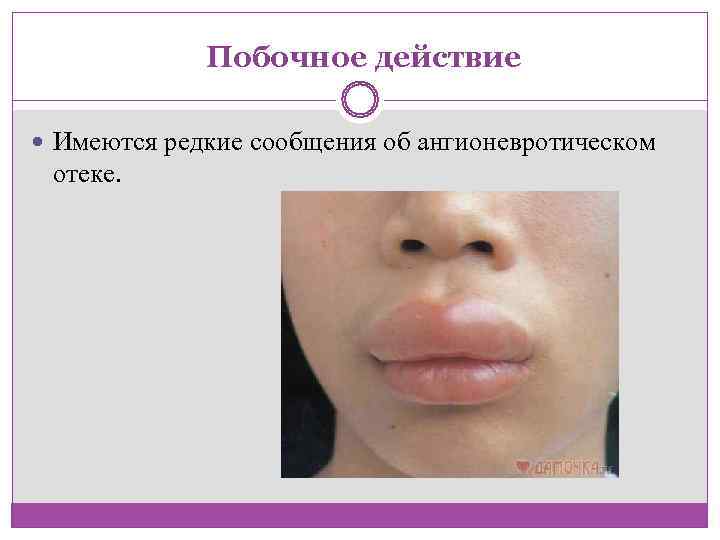    Побочное действие Имеются редкие сообщения об ангионевротическом  отеке.  