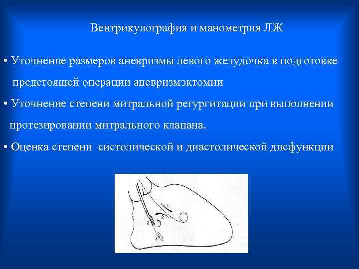 Вентрикулография и манометрия ЛЖ • Уточнение размеров аневризмы левого желудочка в подготовке предстоящей операции