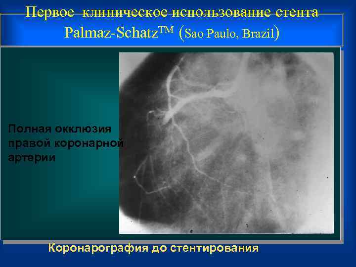 Первое клиническое использование стента Palmaz-Schatz. TM (Sao Paulo, Brazil) Полная окклюзия правой коронарной артерии