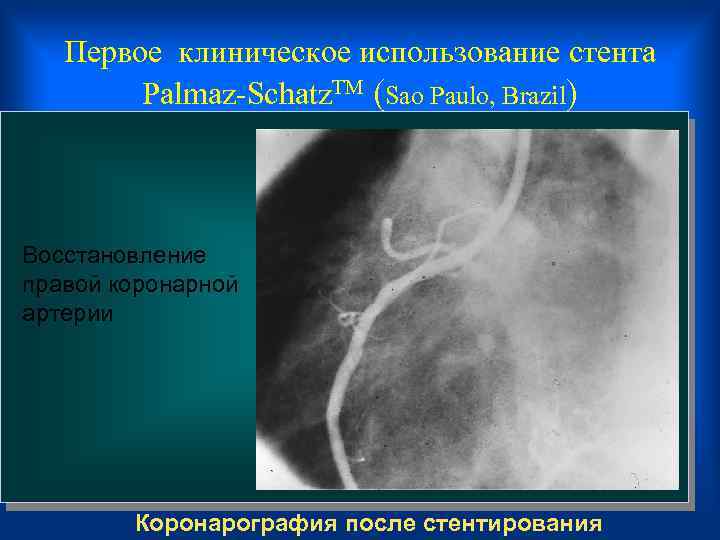 Первое клиническое использование стента Palmaz-Schatz. TM (Sao Paulo, Brazil) Восстановление правой коронарной артерии Коронарография