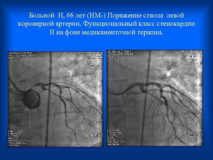 Больной H, 66 лет (ИМ-) Поражение ствола левой коронарной артерии. Функциональный класс стенокардии II