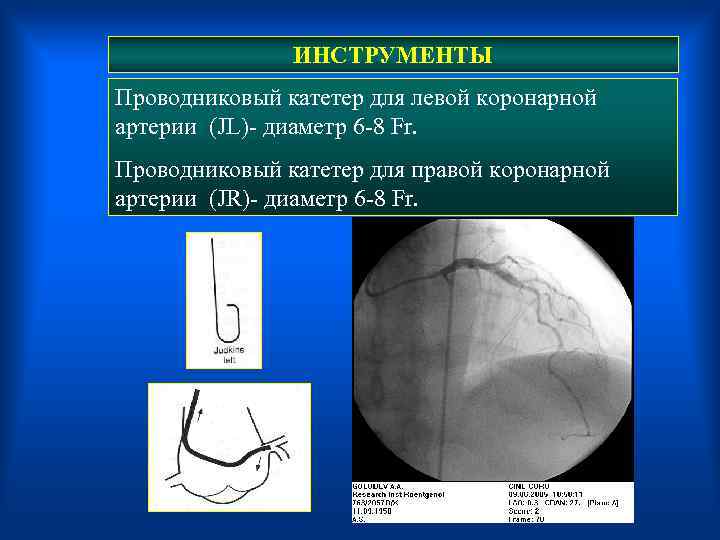 ИНСТРУМЕНТЫ Проводниковый катетер для левой коронарной артерии (JL)- диаметр 6 -8 Fr. Проводниковый катетер
