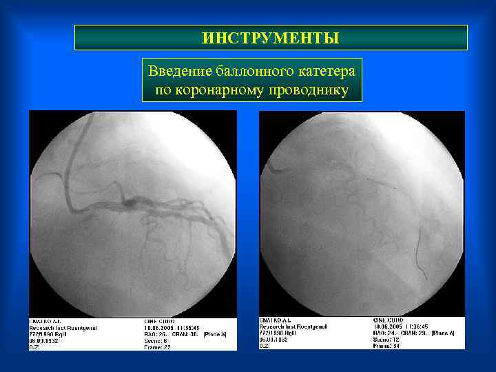 ИНСТРУМЕНТЫ Введение баллонного катетера по коронарному проводнику 