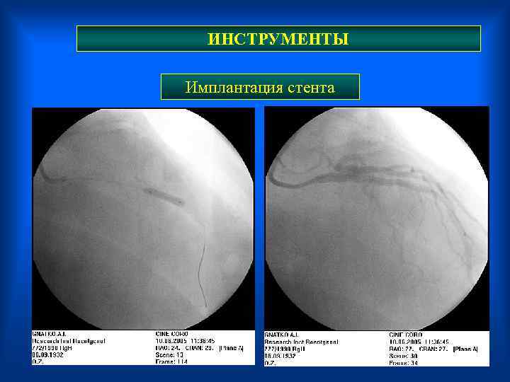 ИНСТРУМЕНТЫ Имплантация стента 