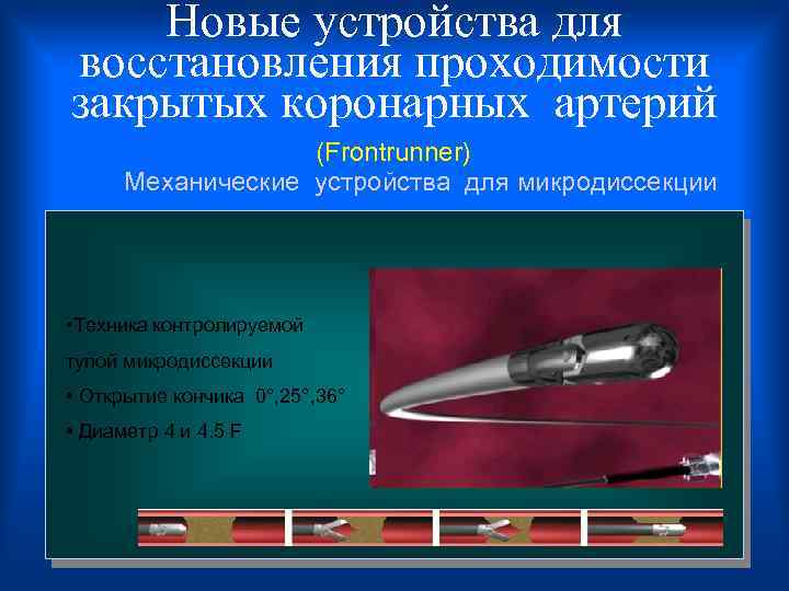 Новые устройства для восстановления проходимости закрытых коронарных артерий (Frontrunner) Механические устройства для микродиссекции •