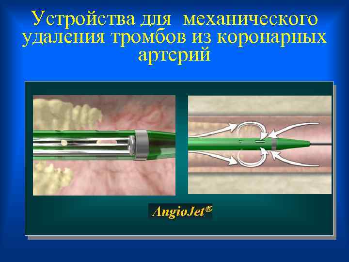 Устройства для механического удаления тромбов из коронарных артерий 