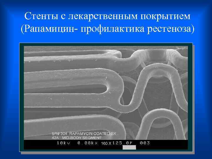 Стенты с лекарственным покрытием (Рапамицин- профилактика рестеноза) 