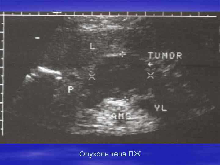 Опухоль тела ПЖ 
