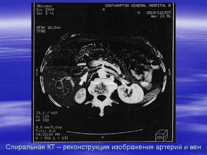 Спиральная КТ – реконструкция изображения артерий и вен 