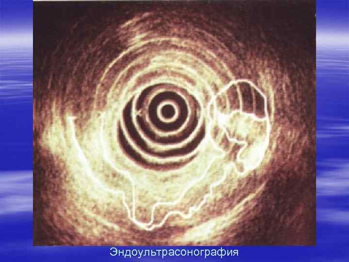 Эндоультрасонография 