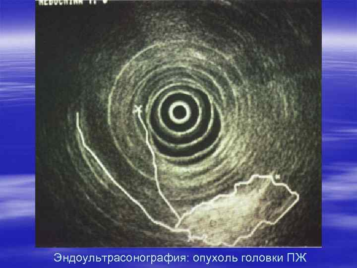 Эндоультрасонография: опухоль головки ПЖ 