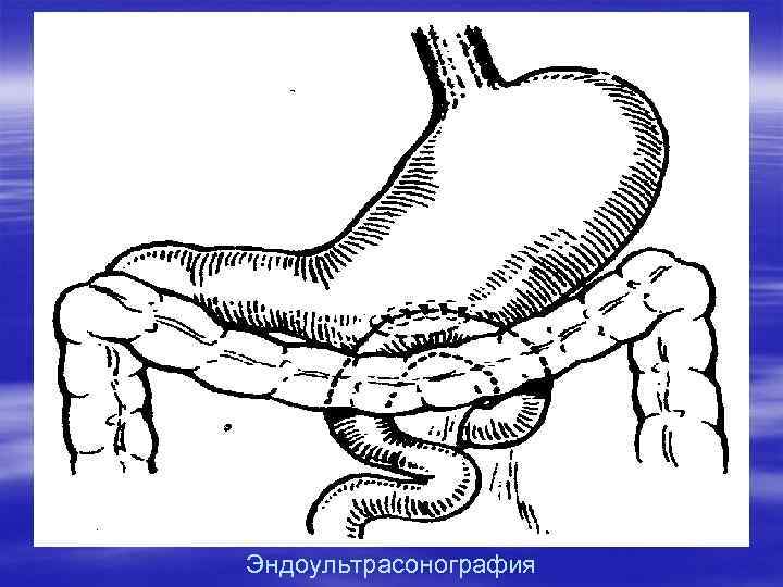 Эндоультрасонография 
