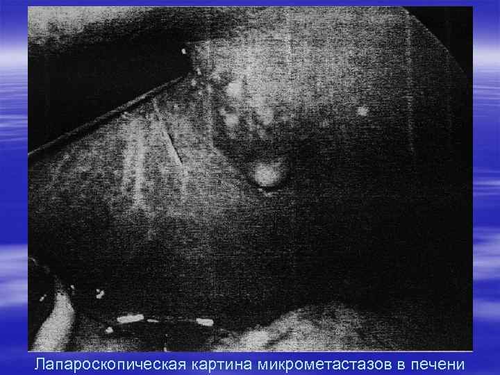 Лапароскопическая картина микрометастазов в печени 
