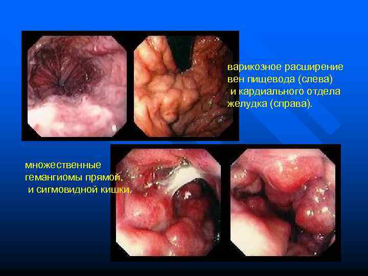 варикозное расширение вен пищевода (слева) и кардиального отдела желудка (справа). множественные гемангиомы прямой и