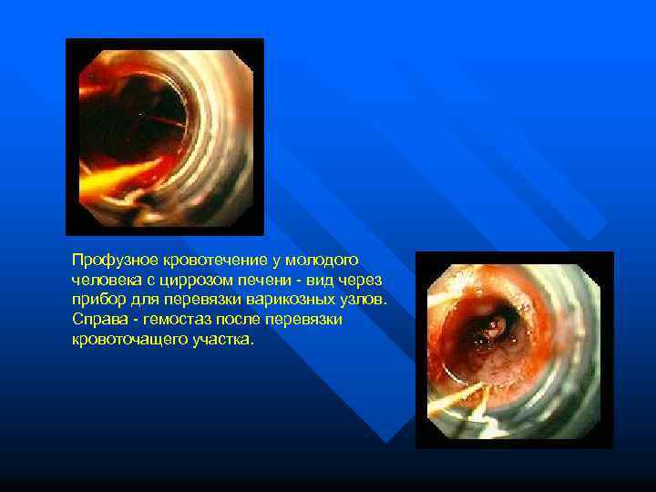 Профузное кровотечение у молодого человека с циррозом печени - вид через прибор для перевязки