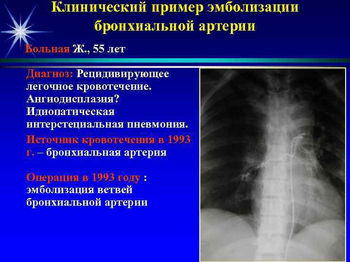   Клинический пример эмболизации   бронхиальной артерии Больная Ж. , 55 лет