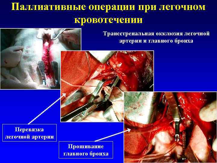  Паллиативные операции при легочном   кровотечении      