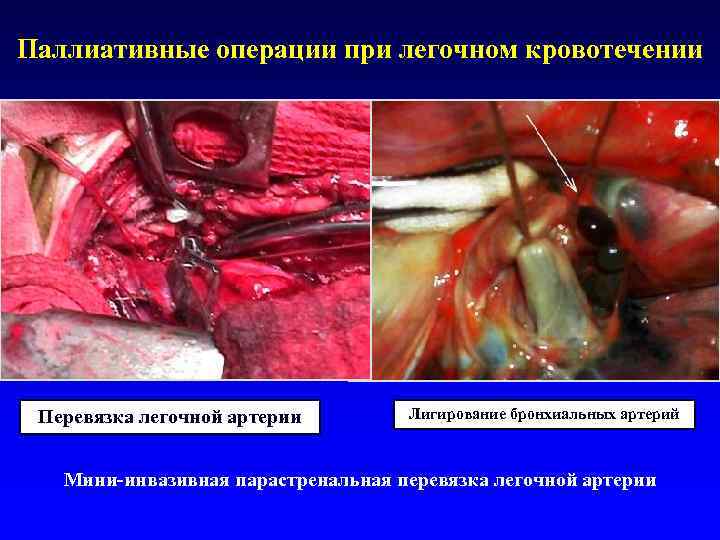 Паллиативные операции при легочном кровотечении Перевязка легочной артерии   Лигирование бронхиальных артерий 