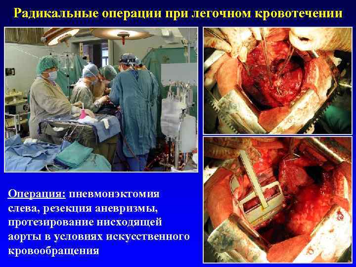 Радикальные операции при легочном кровотечении Операция: пневмонэктомия слева, резекция аневризмы, протезирование нисходящей аорты в