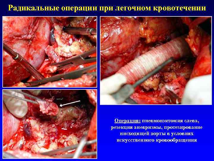 Радикальные операции при легочном кровотечении     Операция: пневмонэктомия слева,  