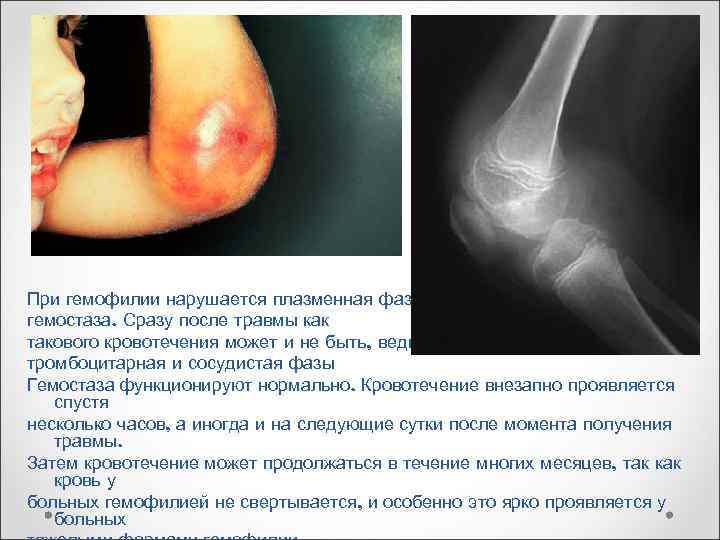 При гемофилии нарушается плазменная фаза гемостаза. Сразу после травмы как такового кровотечения может и