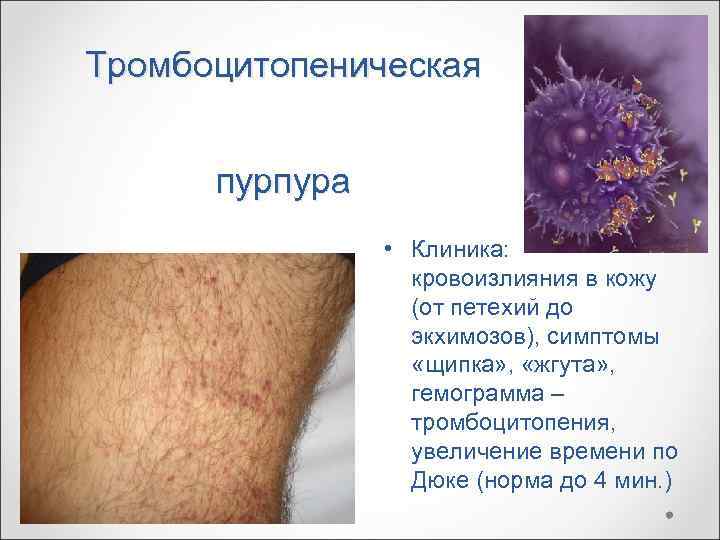 Тромбоцитопеническая   пурпура   • Клиника:    кровоизлияния в кожу
