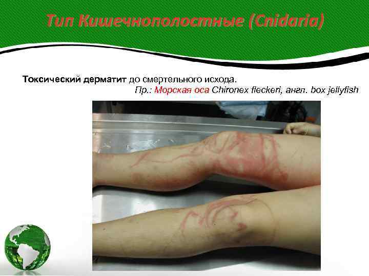  Тип Кишечнополостные (Cnidaria)  Токсический дерматит до смертельного исхода.    