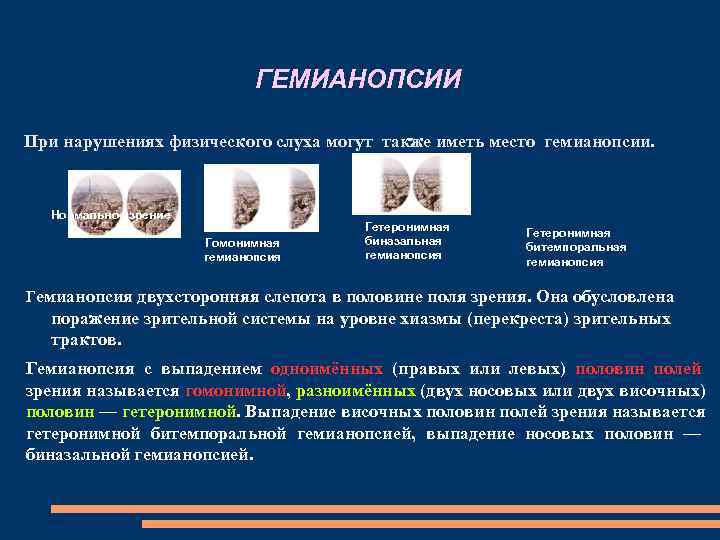ГЕМИАНОПСИИ При нарушениях физического слуха могут также иметь место ГЕМИАНОПСИИ При нарушениях физического слуха могут также иметь место