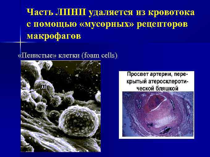 Часть ЛПНП удаляется из кровотока с помощью «мусорных» рецепторов макрофагов «Пенистые» клетки (foam cells)