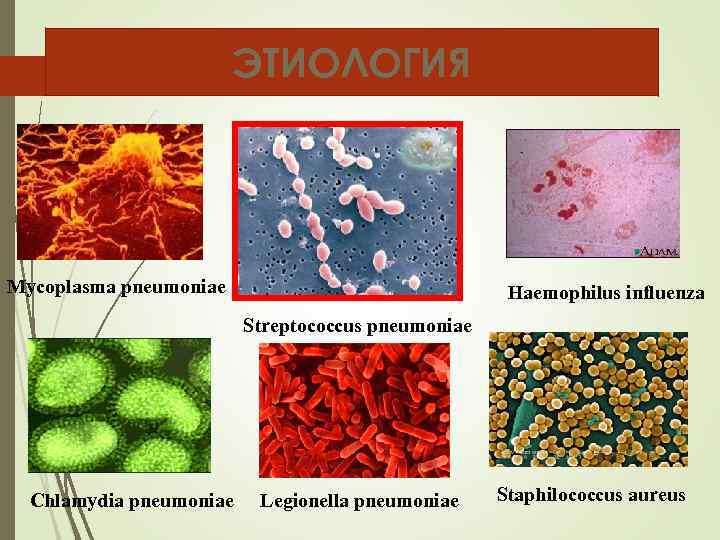     ЭТИОЛОГИЯ Mycoplasma pneumoniae      Haemophilus influenza