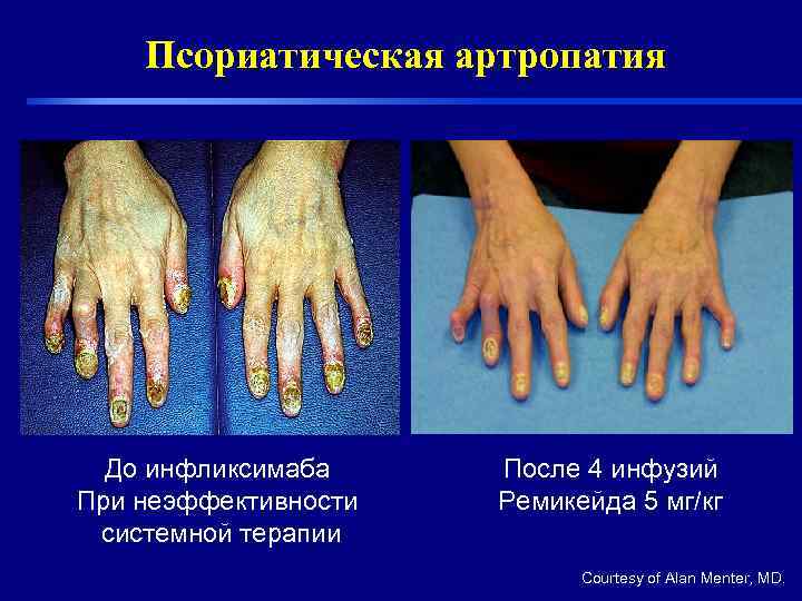  Псориатическая артропатия  До инфликсимаба После 4 инфузий При неэффективности  Ремикейда
