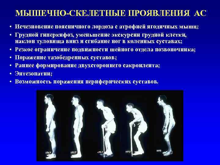  МЫШЕЧНО-СКЕЛЕТНЫЕ ПРОЯВЛЕНИЯ АС • Исчезновение поясничного лордоза с атрофией ягодичных мышц;  •