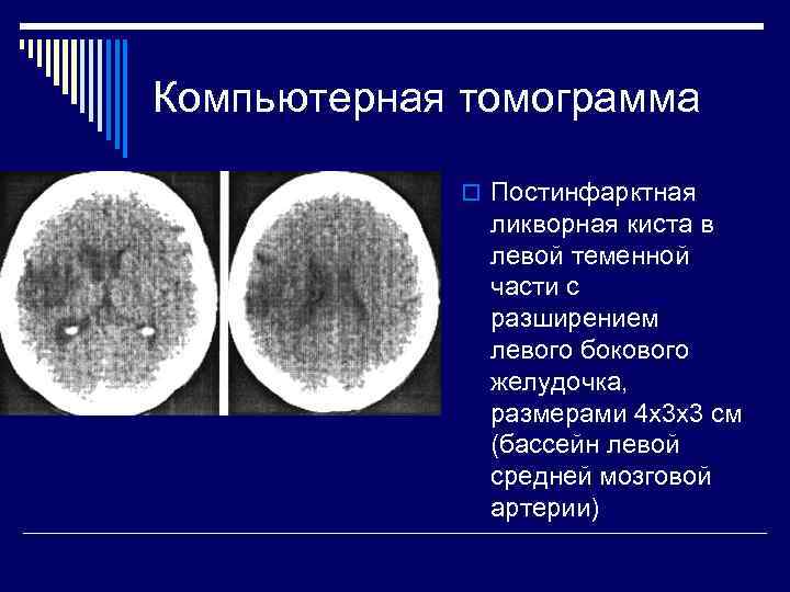 Компьютерная томограмма   o Постинфарктная    ликворная киста в  