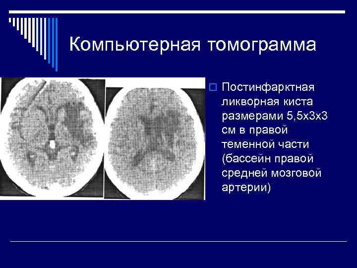 Компьютерная томограмма   o Постинфарктная    ликворная киста   