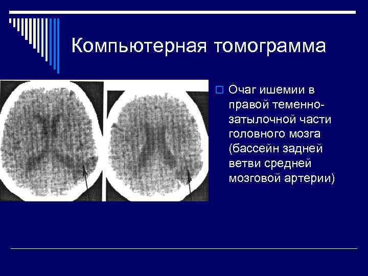 Компьютерная томограмма   o Очаг ишемии в    правой теменно- 