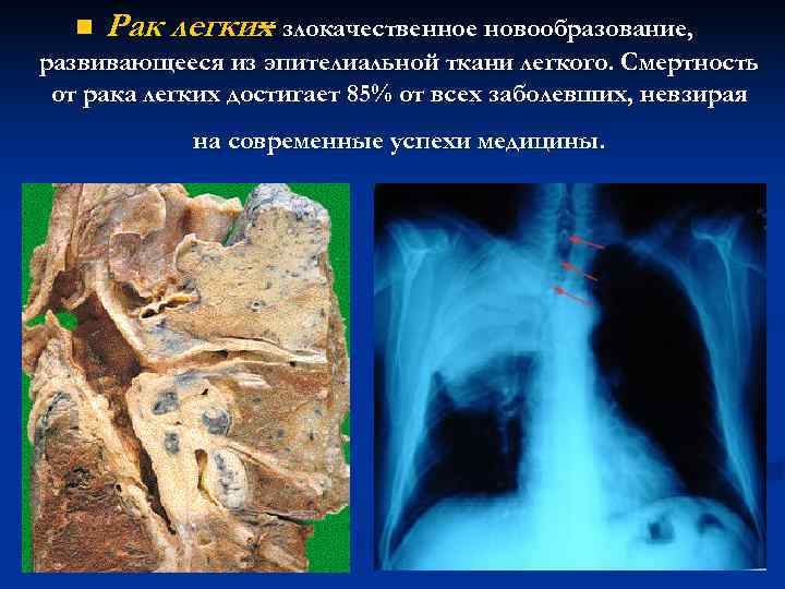 n Рак легких злокачественное новообразование, – развивающееся из эпителиальной n Рак легких злокачественное новообразование, – развивающееся из эпителиальной