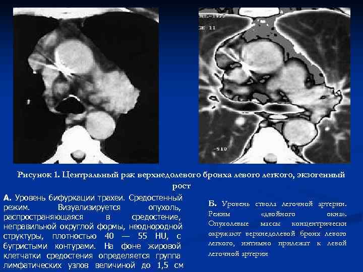 Центральный рак легкого картинки