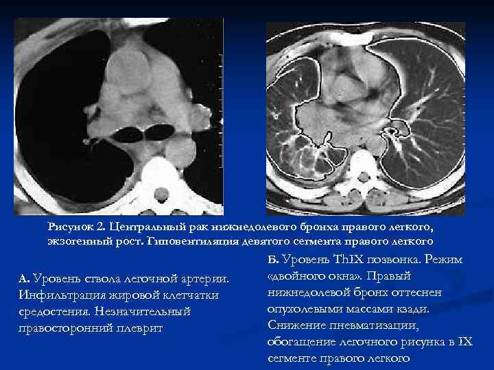 Рисунок 2. Центральный рак нижнедолевого бронха правого легкого, экзогенный рост. Гиповентиляция девятого Рисунок 2. Центральный рак нижнедолевого бронха правого легкого, экзогенный рост. Гиповентиляция девятого