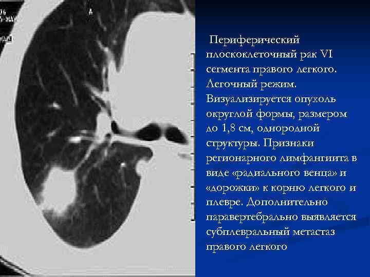 Периферический плоскоклеточный рак VI сегмента правого легкого. Легочный режим. Визуализируется опухоль округлой формы, Периферический плоскоклеточный рак VI сегмента правого легкого. Легочный режим. Визуализируется опухоль округлой формы,
