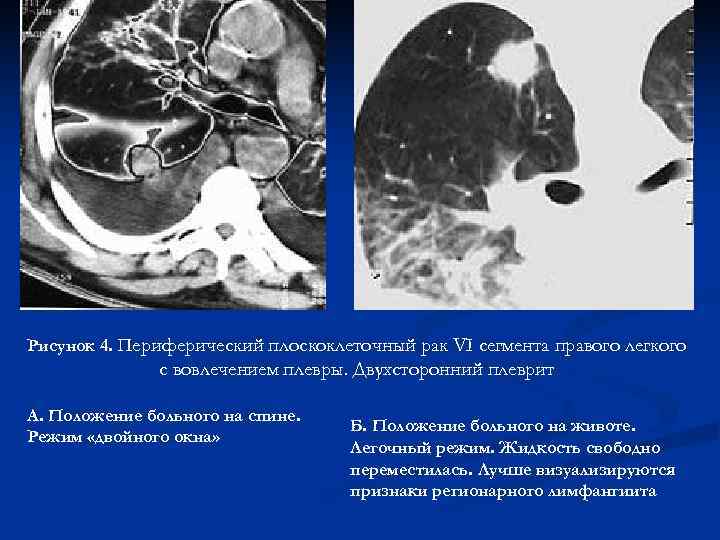 Рак легкого карта вызова скорой медицинской