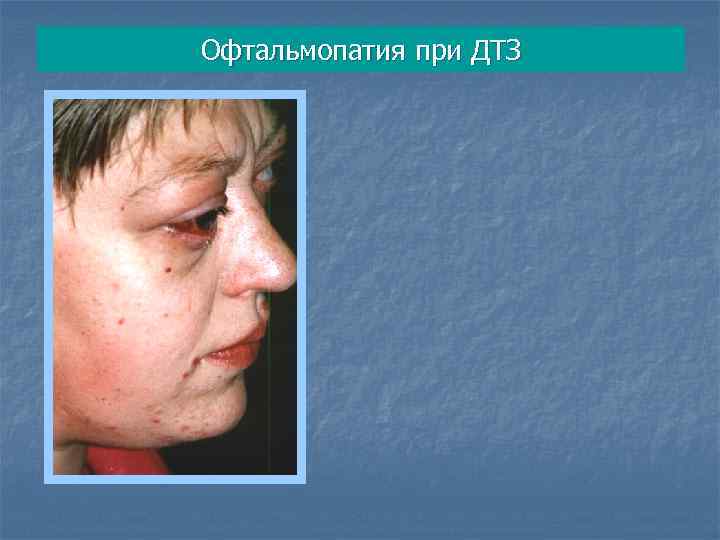 Офтальмопатия при ДТЗ 
