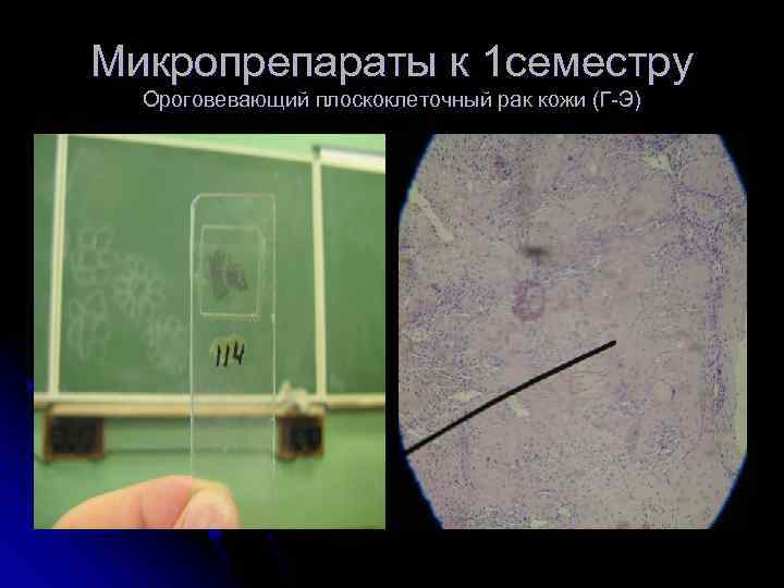 Микропрепараты к 1 семестру Ороговевающий плоскоклеточный рак кожи (Г-Э) 