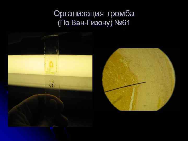 Организация тромба (По Ван-Гизону) № 61 