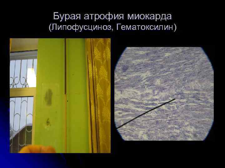 Бурая атрофия миокарда (Липофусциноз, Гематоксилин) 