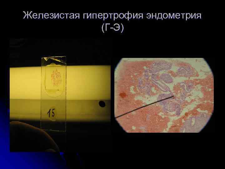 Железистая гипертрофия эндометрия (Г-Э) 