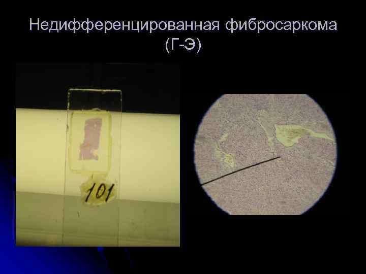 Недифференцированная фибросаркома (Г-Э) 