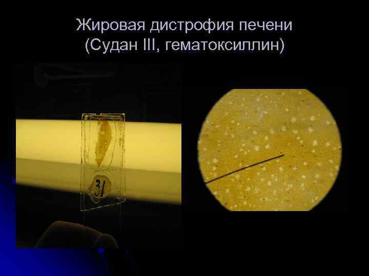 Жировая дистрофия печени (Судан III, гематоксиллин) 